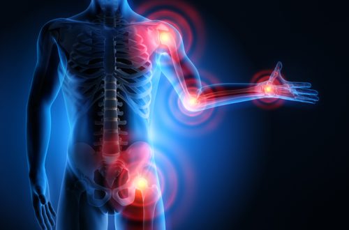 3D Rendering - Starke Schmerzen in den Gelenken - Rheuma und Arthrose