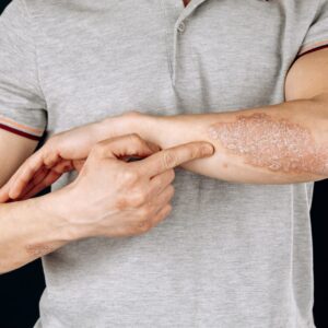 Skin Disorders